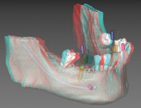 飯塚市の歯医者でインプラント歯科用3DデジタルＣＴ診断でより確実・安全なインプラント治療