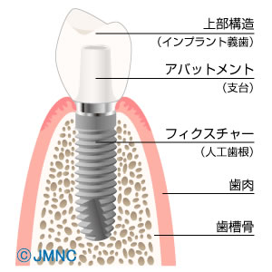 飯塚で最先端インプラントの基本構造