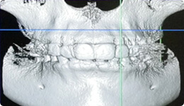 飯塚市 インプラント 審美歯科 歯科 歯医者 美容 審美 白い歯 歯 嘉麻市 田川市 嘉穂郡桂川町　歯科用CT　歯科用デジタルＸ線